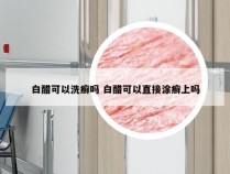 白醋可以洗癣吗 白醋可以直接涂癣上吗