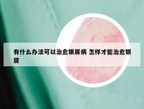 有什么办法可以治愈银屑病 怎样才能治愈银屑