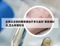 全身红点状的银屑病治疗多久能好 银屑病红点,怎么样算好点