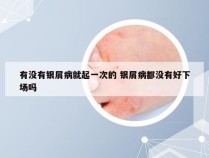 有没有银屑病就起一次的 银屑病都没有好下场吗