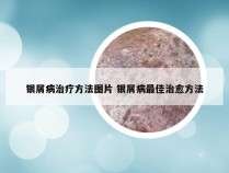 银屑病治疗方法图片 银屑病最佳治愈方法