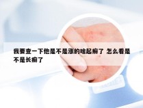 我要查一下他是不是涨的啥起癣了 怎么看是不是长癣了