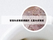 宝宝头皮银屑病图片 儿童头皮银屑