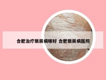 合肥治疗银屑病哪好 合肥银屑病医院