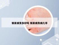 银屑病发多好吗 银屑病发病几率