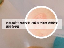 河南治疗牛皮癣专家 河南治疗银屑病最好的医院在哪里