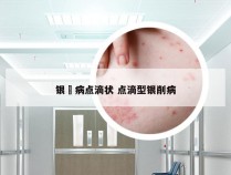 银痟病点滴状 点滴型银削病