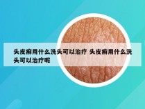 头皮癣用什么洗头可以治疗 头皮癣用什么洗头可以治疗呢