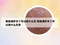 银屑病怀孕了可以擦什么药 银屑病怀孕了可以擦什么药膏