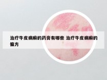 治疗牛皮病癣的药膏有哪些 治疗牛皮病癣的偏方