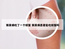 银屑病吃了一个螃蟹 银屑病患者能吃螃蟹吗