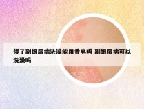 得了副银屑病洗澡能用香皂吗 副银屑病可以洗澡吗