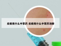 皮癣用什么中草药 皮癣用什么中草药泡脚