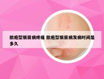 脓疱型银屑病疼痛 脓疱型银屑病发病时间是多久