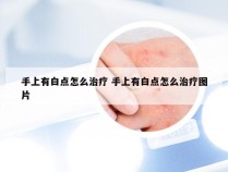 手上有白点怎么治疗 手上有白点怎么治疗图片