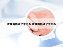 皮肤癣抓破了怎么办 皮肤癣抓破了怎么办