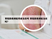 掌跖脓疱病能彻底治愈吗 掌跖脓疱病能治愈吗?