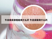 牛皮癣皮肤粗糙用什么药 牛皮顽癣用什么药