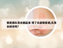 银屑病头发会翘起来 得了头部银屑病,头发会掉光吗?