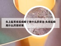 头上起宵皮后成癣了用什么药膏治 头皮起癣用什么药膏好用