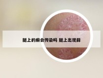 腿上的癣会传染吗 腿上出现藓