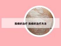 股癣的治疗 股癣的治疗方法