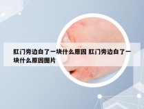 肛门旁边白了一块什么原因 肛门旁边白了一块什么原因图片