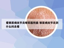 看银屑病关节炎哪家医院最 银屑病关节炎到什么科去看