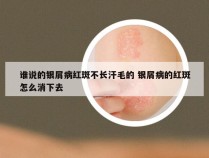 谁说的银屑病红斑不长汗毛的 银屑病的红斑怎么消下去