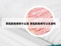 掌跖脓疱病穿什么鞋 掌跖脓疱病可以洗澡吗