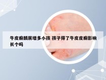 牛皮癣麟屑增多小孩 孩子得了牛皮皮癣影响长个吗