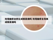 玫瑰糠疹会转化成银屑病吗 玫瑰糠疹会发展成银屑病吗