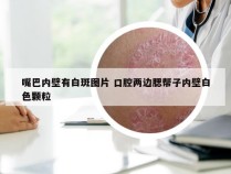 嘴巴内壁有白斑图片 口腔两边腮帮子内壁白色颗粒