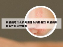 银屑病吃什么药外用什么药最有效 银屑病用什么外用药效果好