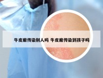 牛皮廨传染别人吗 牛皮廨传染到孩子吗