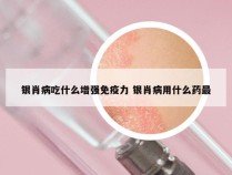 银肖病吃什么增强免疫力 银肖病用什么药最