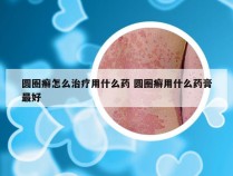 圆圈癣怎么治疗用什么药 圆圈癣用什么药膏最好