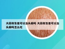 大蒜和生姜可以治头癣吗 大蒜和生姜可以治头癣吗怎么吃