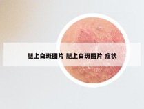 腿上白斑图片 腿上白斑图片 症状