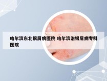 哈尔滨东北银屑病医院 哈尔滨治银屑病专科医院