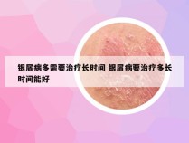 银屑病多需要治疗长时间 银屑病要治疗多长时间能好