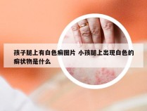 孩子腿上有白色癣图片 小孩腿上出现白色的癣状物是什么