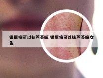 银屑病可以抹芦荟嘛 银屑病可以抹芦荟嘛女生