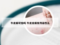 牛皮癣可怕吗 牛皮皮癣有传染性么