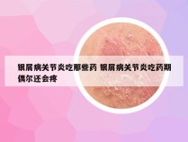 银屑病关节炎吃那些药 银屑病关节炎吃药期偶尔还会疼