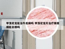 甲泼尼龙能治牛皮癣吗 甲泼尼龙片治疗银屑病能去根吗