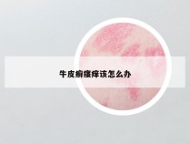 牛皮癣瘙痒该怎么办