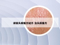 顽固头癣偏方秘方 治头藓偏方