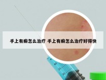 手上有癣怎么治疗 手上有癣怎么治疗好得快