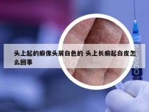 头上起的癣像头屑白色的 头上长癣起白皮怎么回事